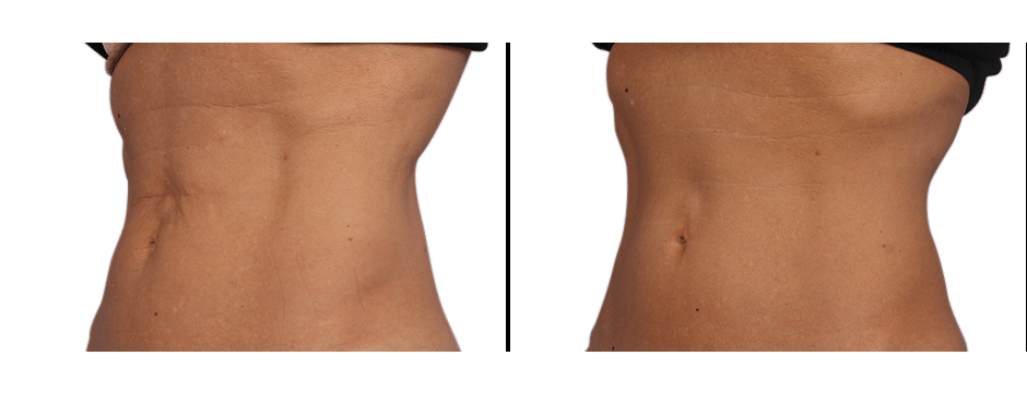 CoolSculpting near me Advanced Skin & Body